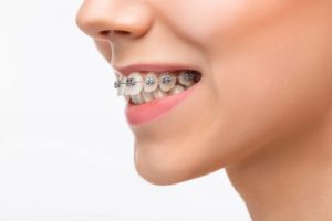 detailed look at metal braces