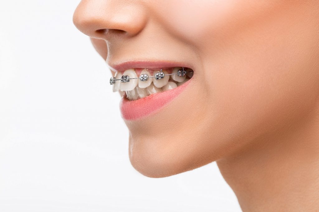 women with braces
