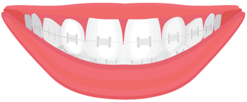 ceramic braces illustration