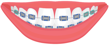 traditional braces illustration